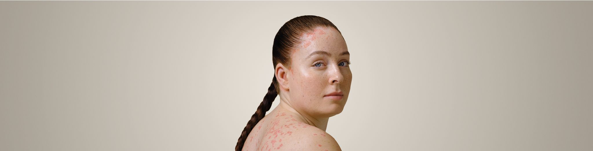 Hero Image Psoriasis Story