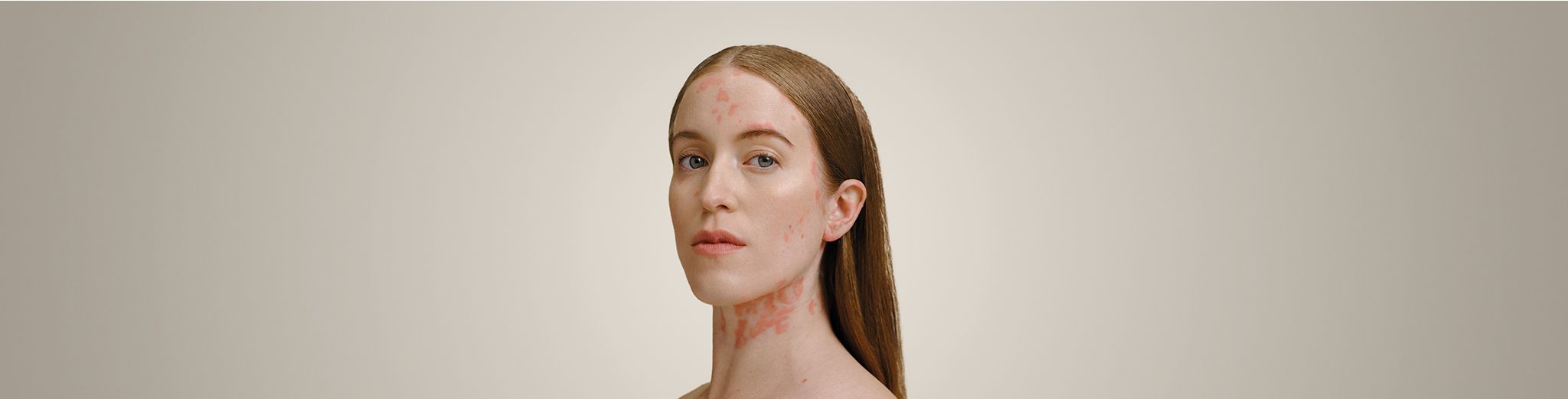 Hero Image Understanding Psoriasis